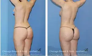 best bbl brazilian butt lift before after photo chicago breast and body1 copia