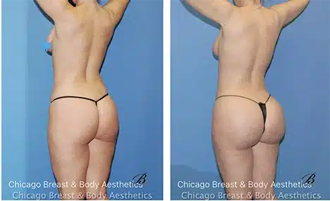 best-bbl-brazilian-butt-lift-before-after-photo-chicago-breast-and-body1 copia