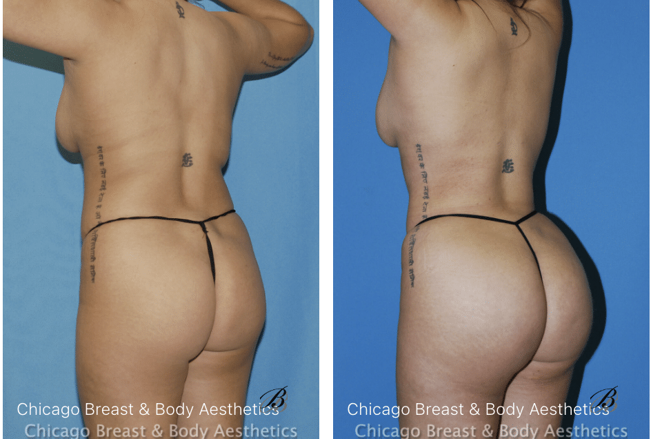 brazilian butt lift before and after photo - chicago breast and body