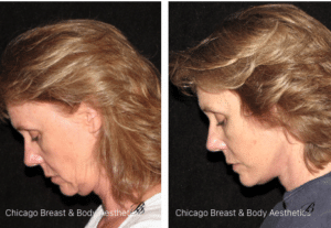 Facelift before and after photo - chicago breast and body