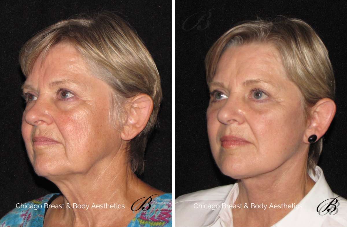 Facelift Before After 50s 1 Chicago Breast Body Aesthetics   Facelift Before After 50s 1 