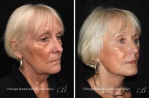 best facelift before and photo - Chicago facial plastic surgeon