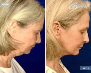 Lower neck lift before after photo 50s