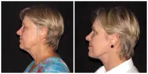 lower neck lift surgery before and after photo by dr francine vagotis