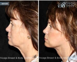 Lower neck lift photo before after by Dr. Francine Vagotis