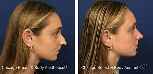 facelift-surgery-chicago
