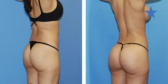 skinny-bbl-surgery-panorama copia