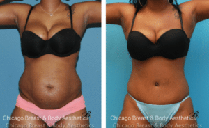 tummy tuck before after photos chicago breast and body1