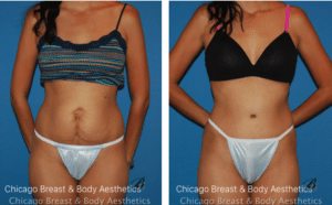 tummy tuck before after photos chicago breast and body10