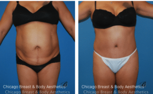 best tummy tuck before and after photos. Chicago Breast and Body Aesthetics - Plastic Surgery FAQ