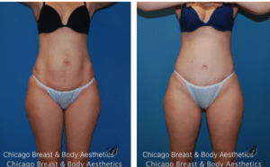tummy tuck before after photos chicago breast and body2