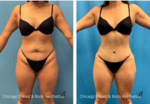 tummy tuck before after photos chicago breast and body6
