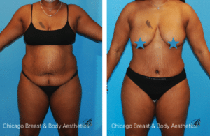 tummy tuck before after photos chicago breast and body8