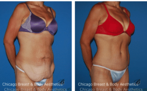 tummy tuck before after photos chicago breast and body9