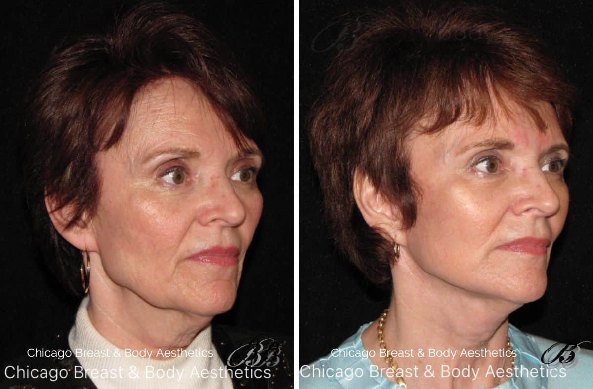 best facelift surgeon before and after in chicago illinois