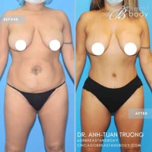 Tummy Tuck Before & After - What are the benefits of a tummy tuck? Chicago Breast & Body Aesthetics