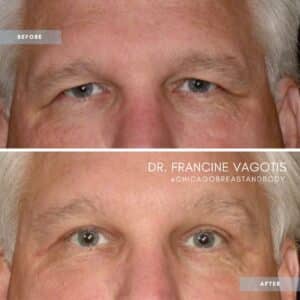 blepharoplasty surgery before after by dr francine vagotis chicago