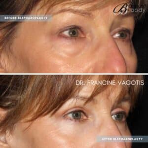 eyebag surgery blepharoplasty before and after by chicagobreastandbody.com