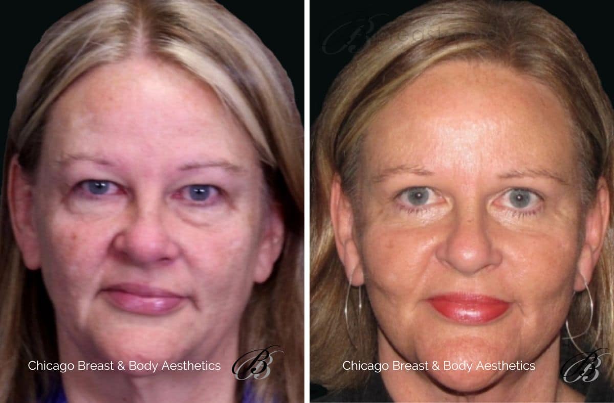 how much does facelift cost in chicago - chicagobreastandbody.com