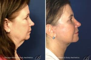 necklift surgery before after by Dr. Francine Vagotis - Chicago Breast & Body Aesthetics