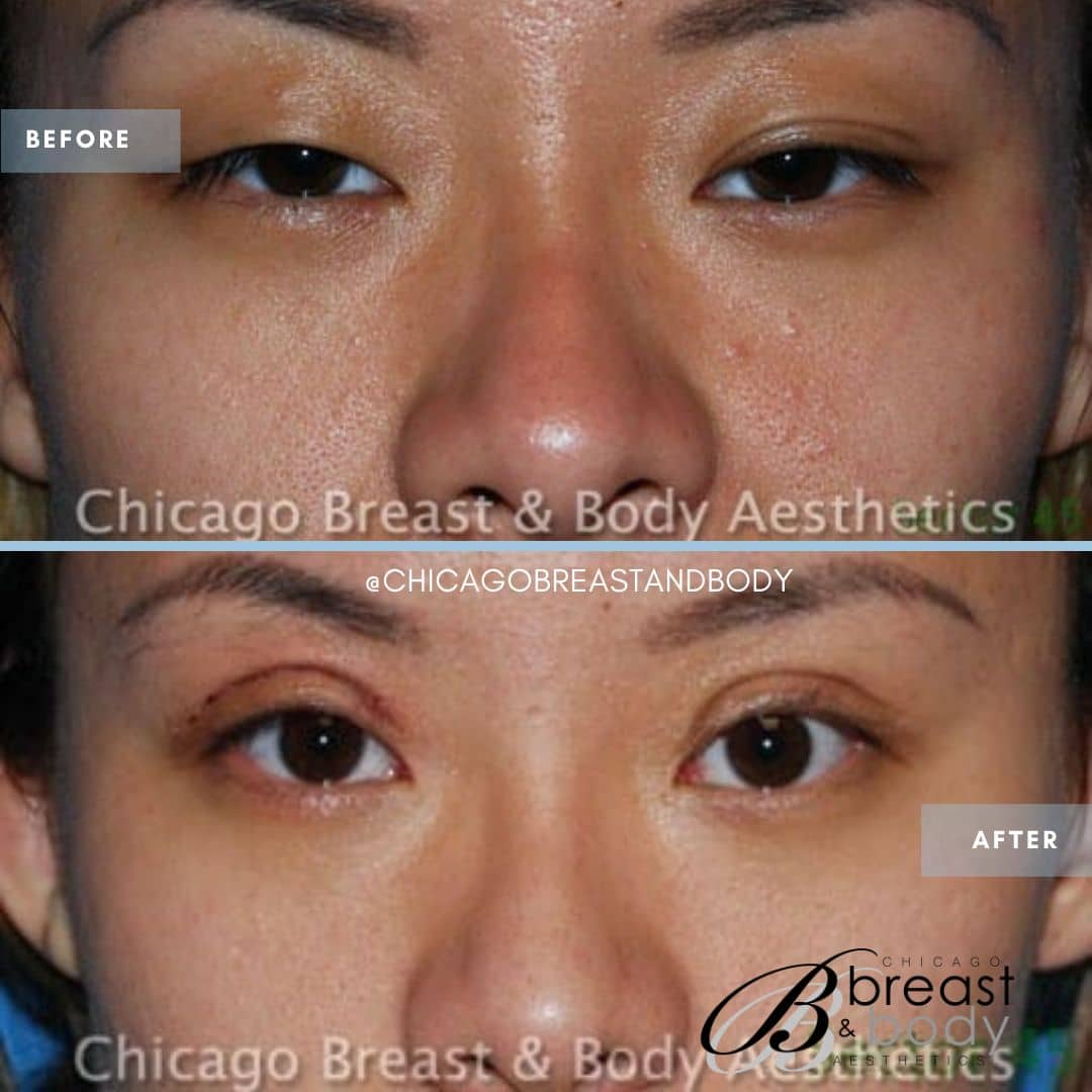 asian eyelid surgery before and after - chicagobreastandbody.com