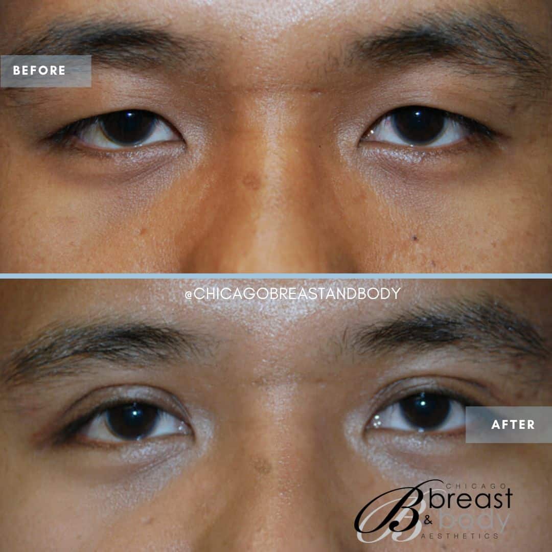asian eyelid surgery before and after photo - chicagobreastandbody.com