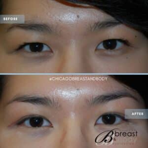 asian double eyelid lift before and after surgery by Chicago Breast & Body