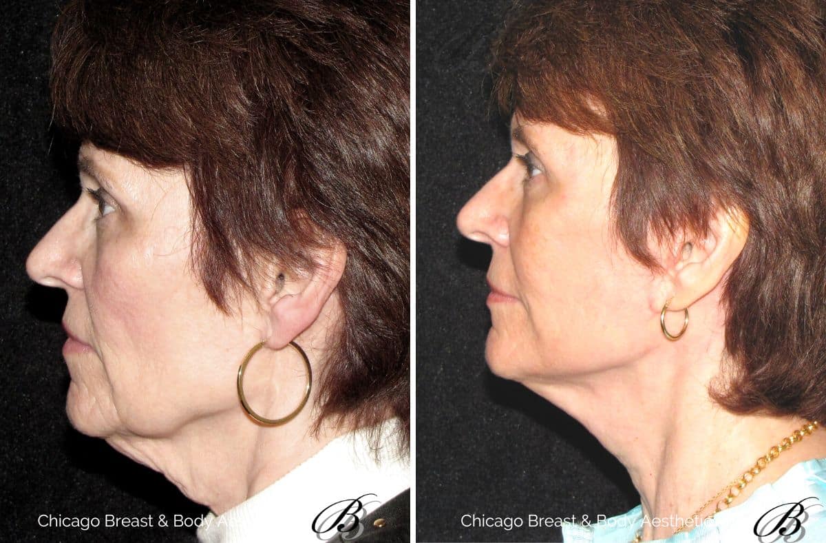 best necklift facial plastic surgeon chicago, illinois