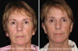 What is the recovery time for facelift surgery?