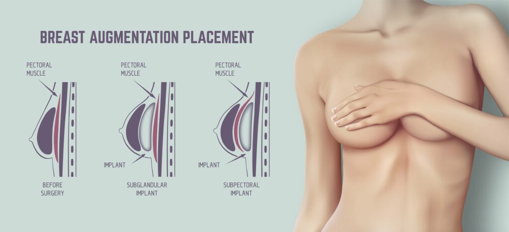 Breast Augmentation Chicago - Silicone / Saline Breast Implants