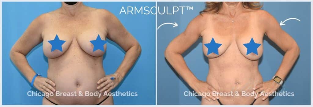 arm Lipo before and after photo - Chicago Breast And Body