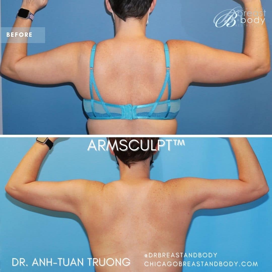 liposuction of arms before and after - Dr. Anh-Tuan Truong Chicago Breast and Body