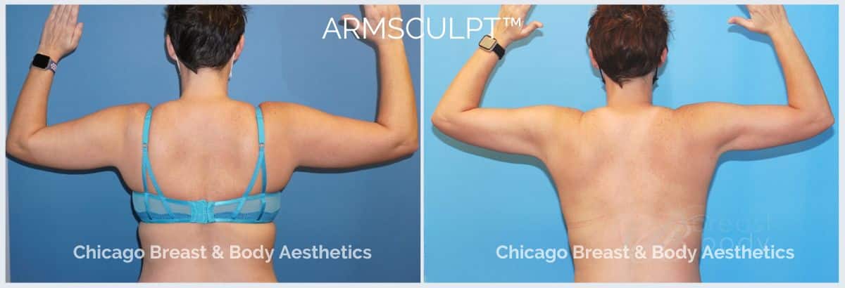 Arm Lipo before and after photo - ArmSculpt- Dr. ANH-TUAN TRUONG - Chicago Breast And Body