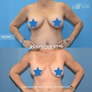 Who is a good candidate for arm lipo? Chicago Breast And Body