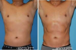 Emsculpt before and after abdomen male - Chicago Aesthetics