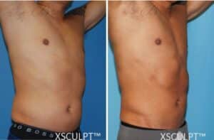 Emsculpt before and after abdomen male - Chicago Aesthetics