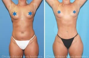 Is hip augmentation surgery safe?