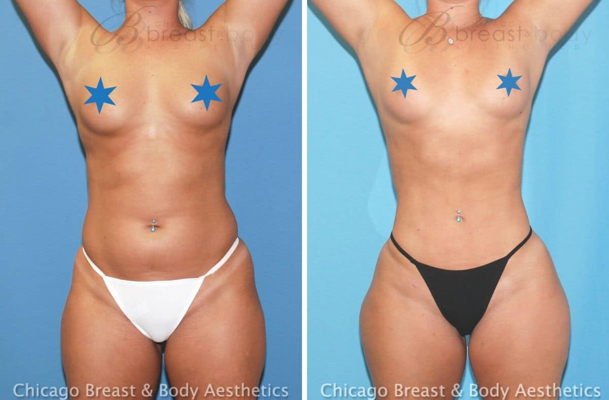 C Cup Breast Augmentation: Enhancing Your Curves Naturally