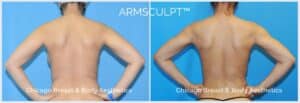arm lipo price - Chicago Breast And Body - Dr. Anh-Tuan Truong
