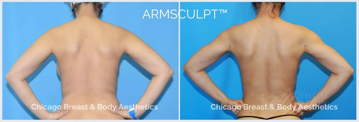 arm lipo price - Chicago Breast And Body - Dr. Anh-Tuan Truong