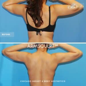 How much does arm liposuction cost? Chicago Breast And Body