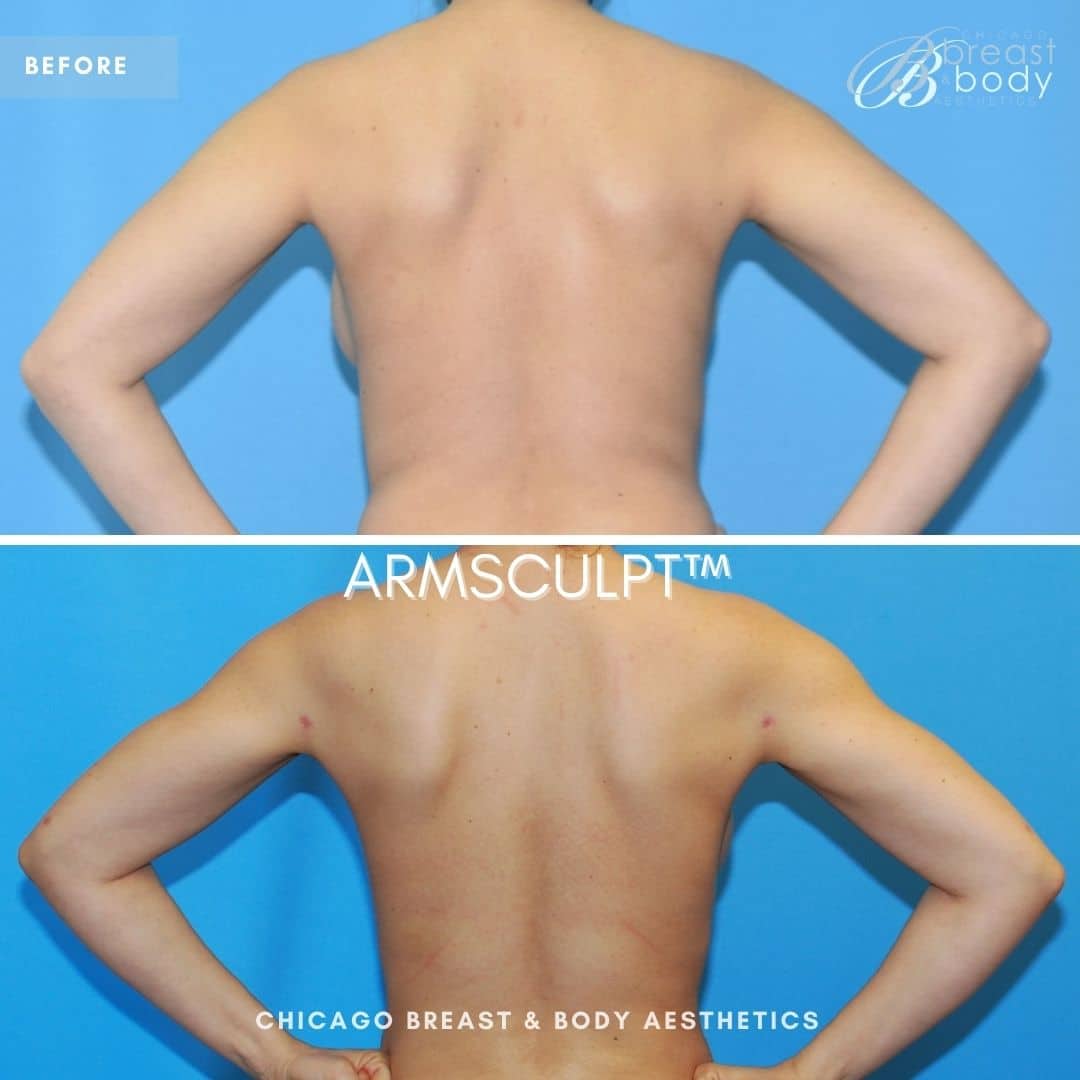 Is arm lipo permanent? Chicago Breast And Body