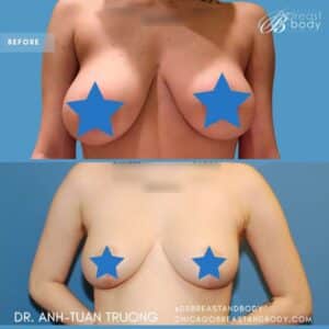 breast reduction surgery near me - chicago breast and body