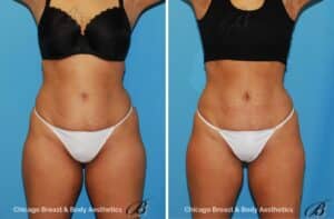 Emsculpt before and after 4 treatments of the abdomen. 6 weeks post.