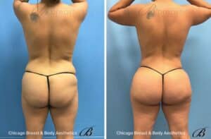 Hip Augmentation surgery before and after by Dr. Kevin Lin Chicago Breast & Body