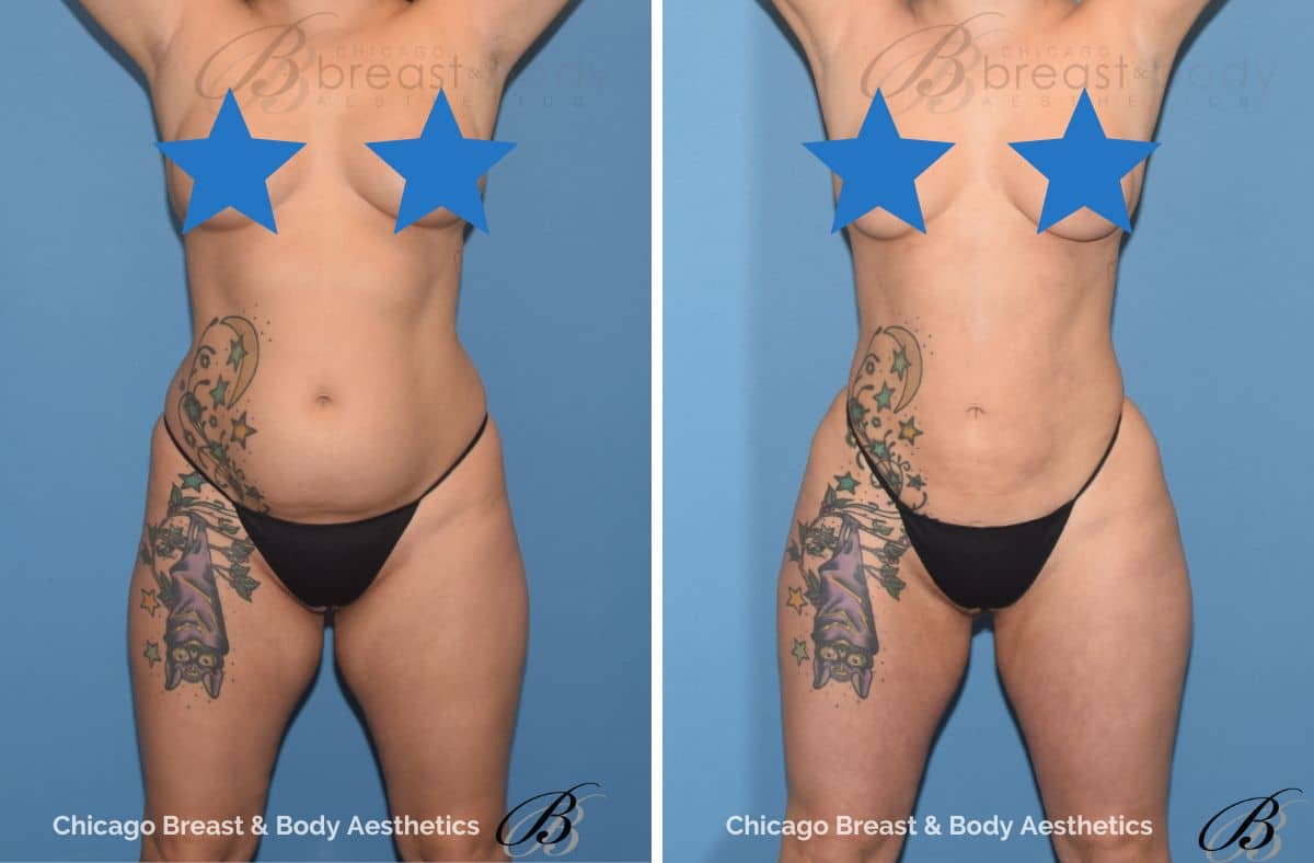 Hip augmentation surgery before and after
