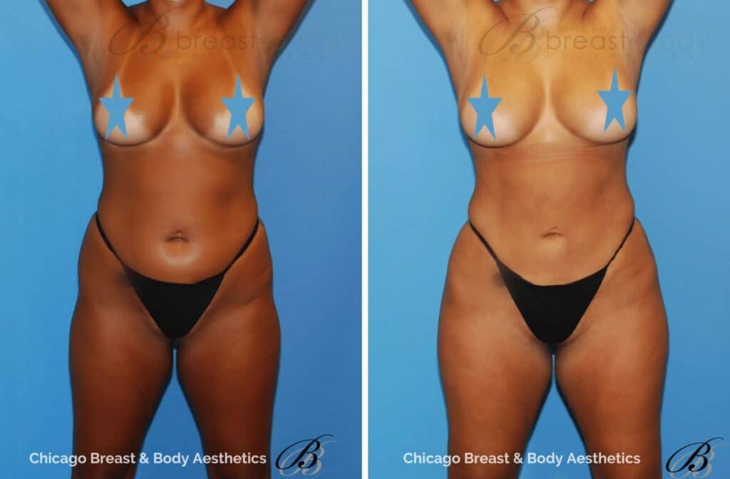 hip augmentation before and after photo by Dr. Anh-Tuan Truong