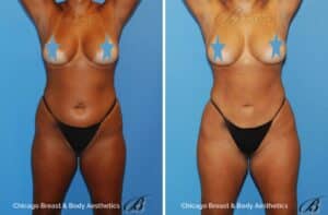 hip augmentation before and after photo by Dr. Anh-Tuan Truong