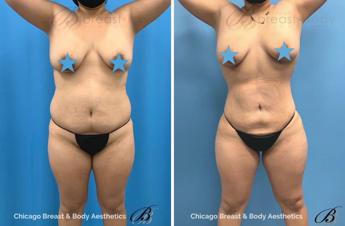 I'm a healthy 22-year-old woman with an athletic shape I would like to know  if I can get a BBL & silicon hip implants? (Photos)