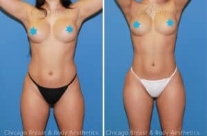 hip fat transfer surgery before and after - Chicago breast and body
